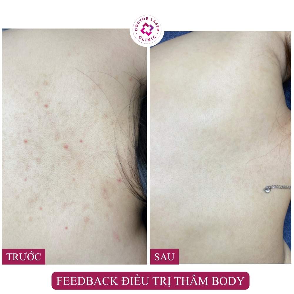 điều trị thâm lưng