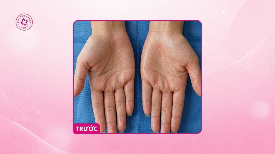 đổ mồ hôi tay nhiều trước điều trị