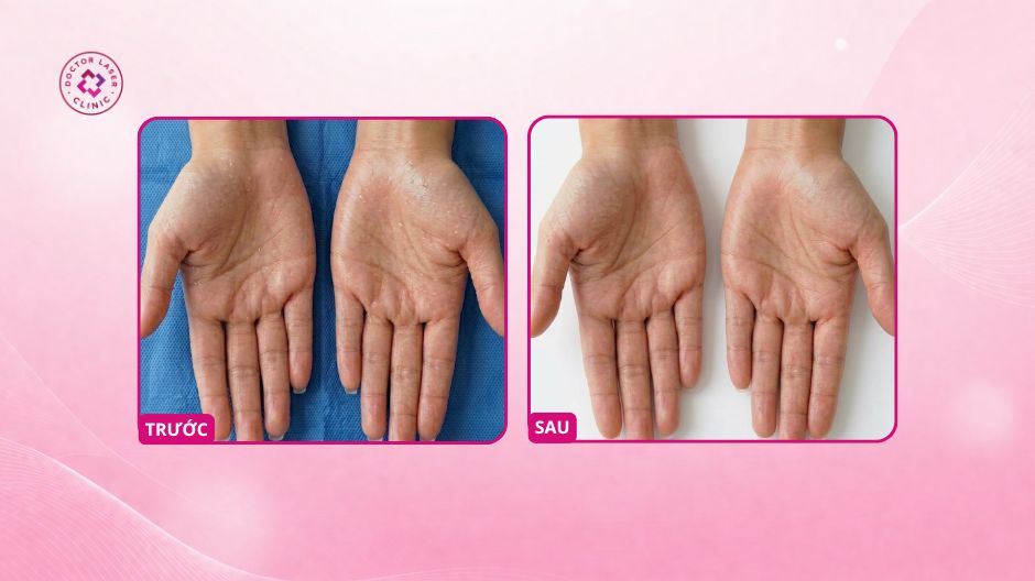 đổ mồ hôi tay sau tiêm botulinum toxin