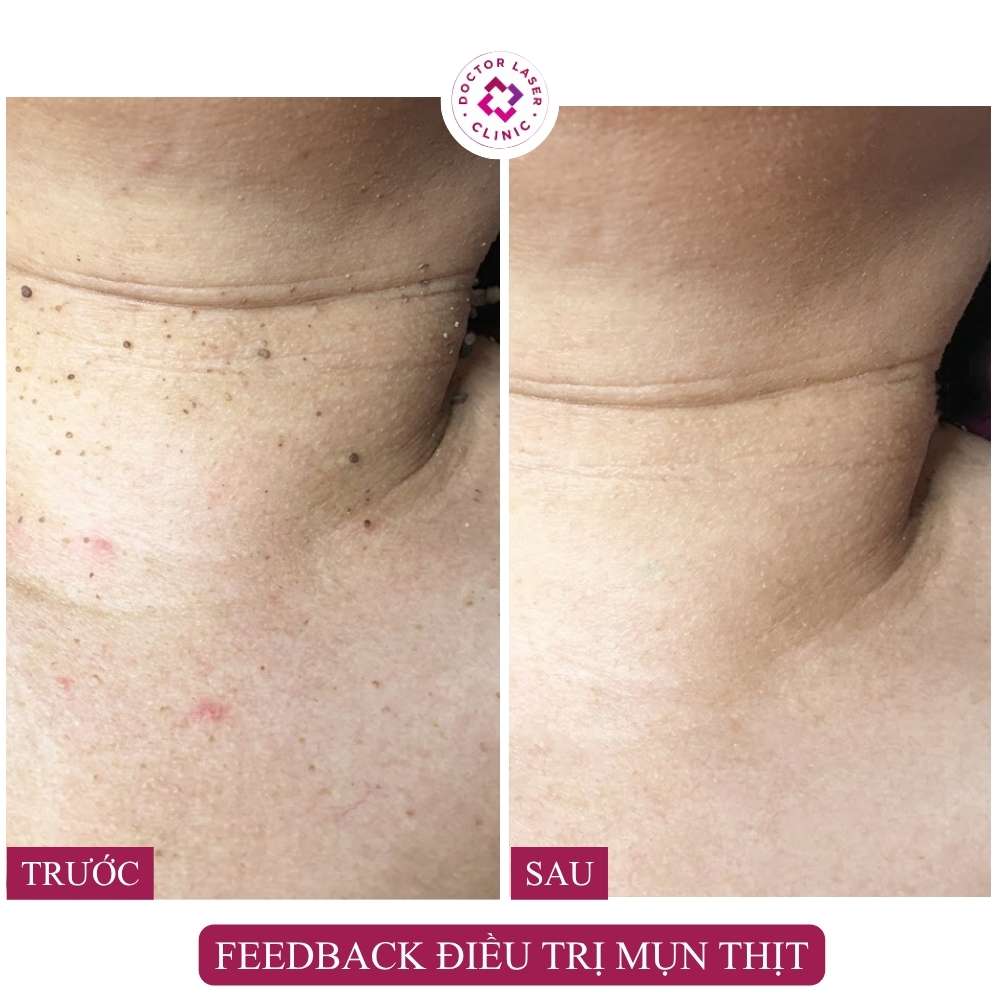 feedback-dieu-tri-mun-thit-co