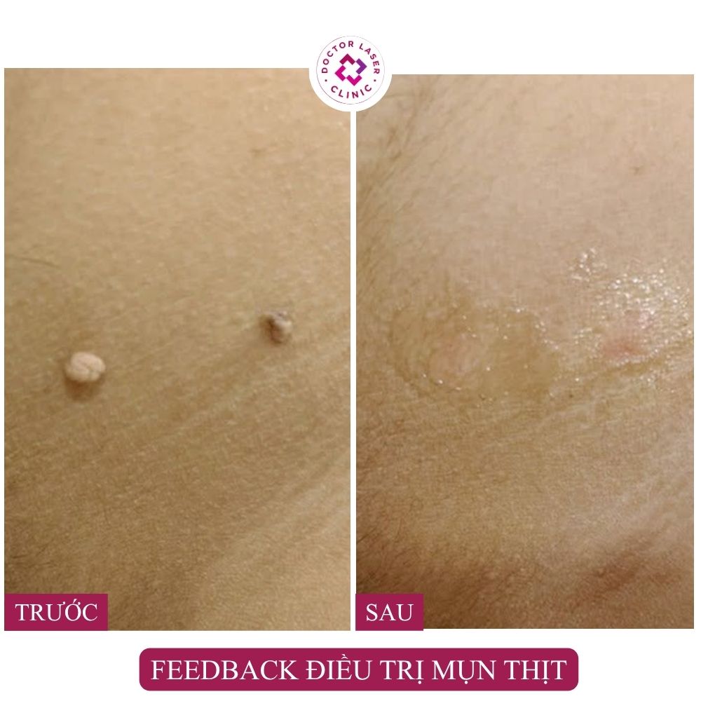 feedback-dieu-tri-mun-thit