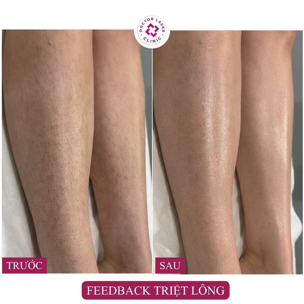 feedback triệt lông chân