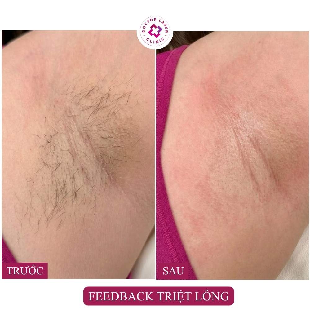 feedback triệt lông nách