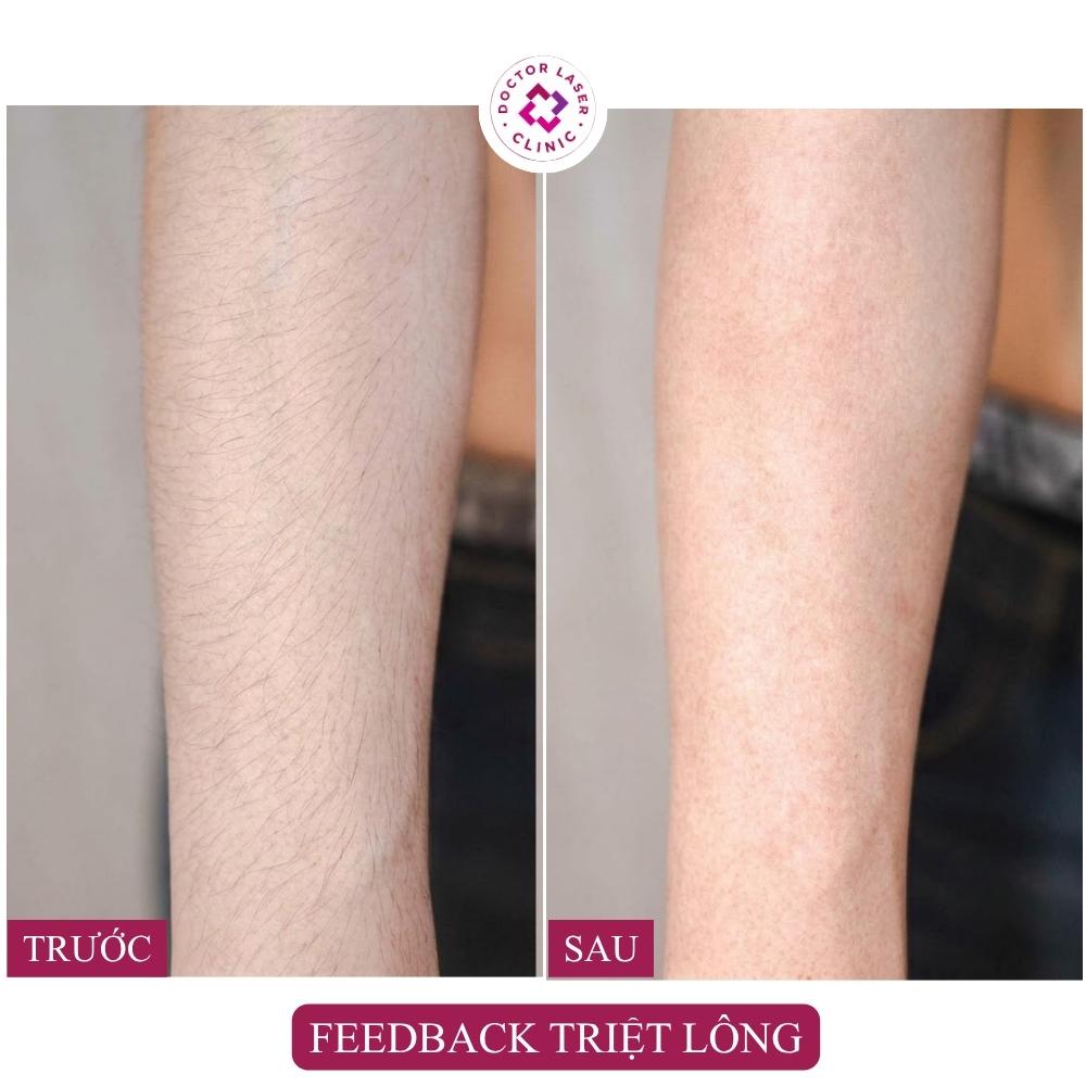 feedback triệt lông tay