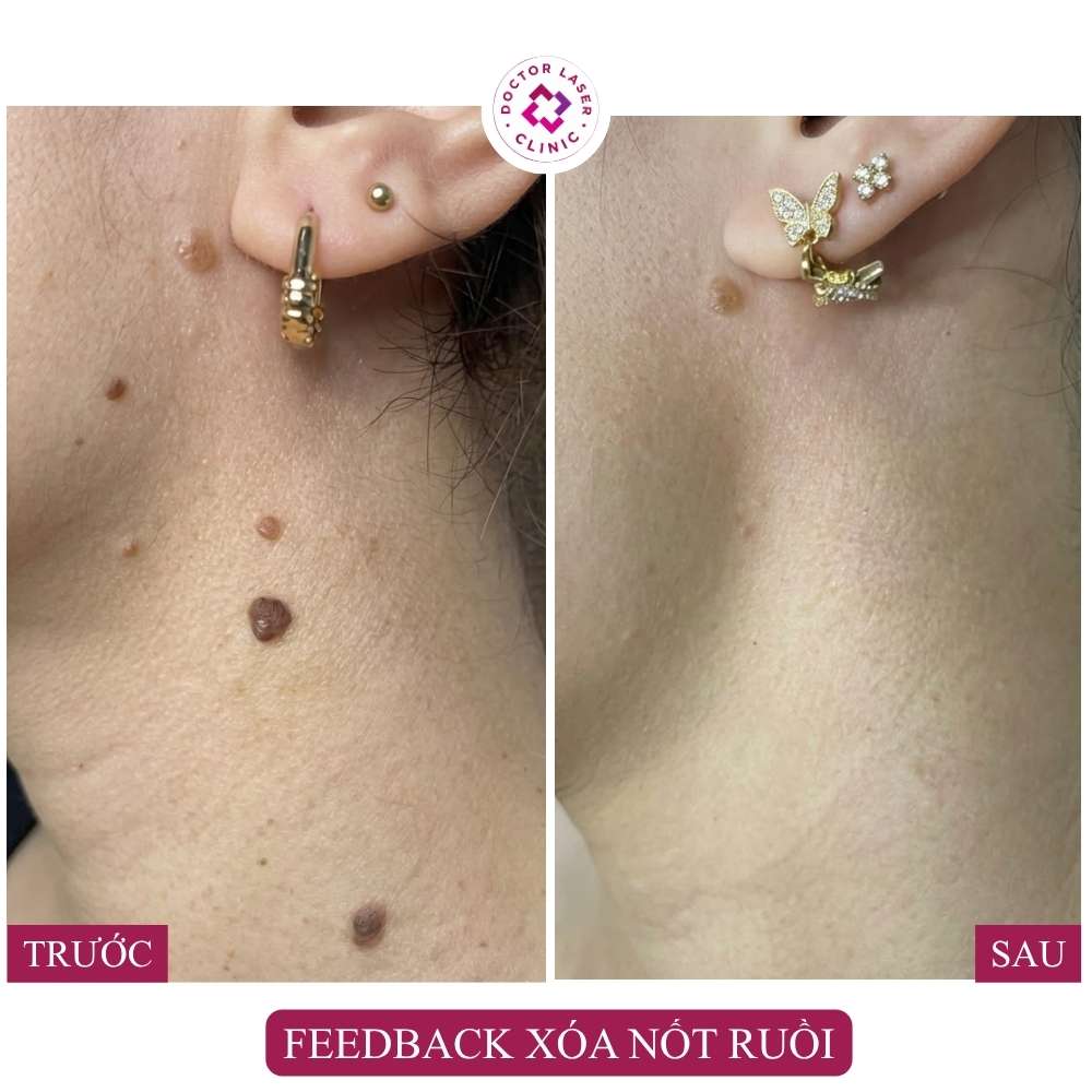 feedback xóa nốt ruồi cổ