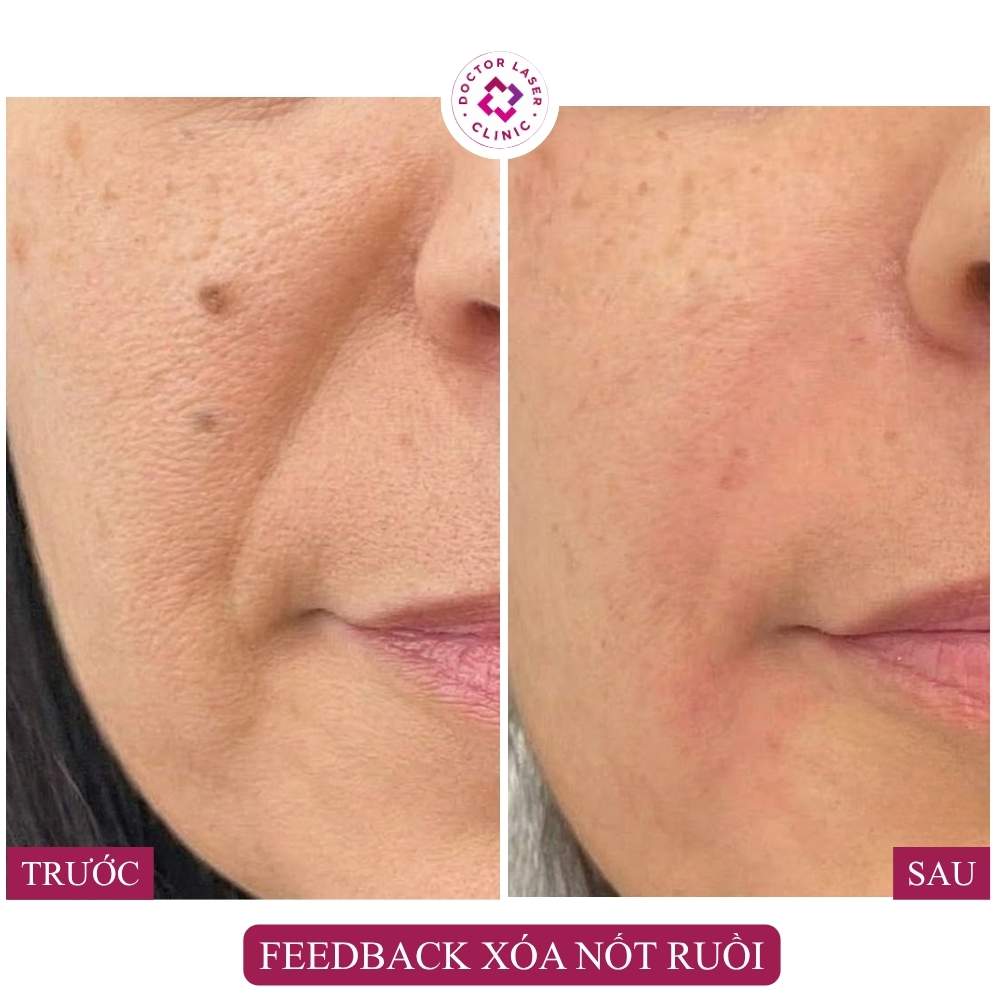 feedback xóa nốt ruồi mặt