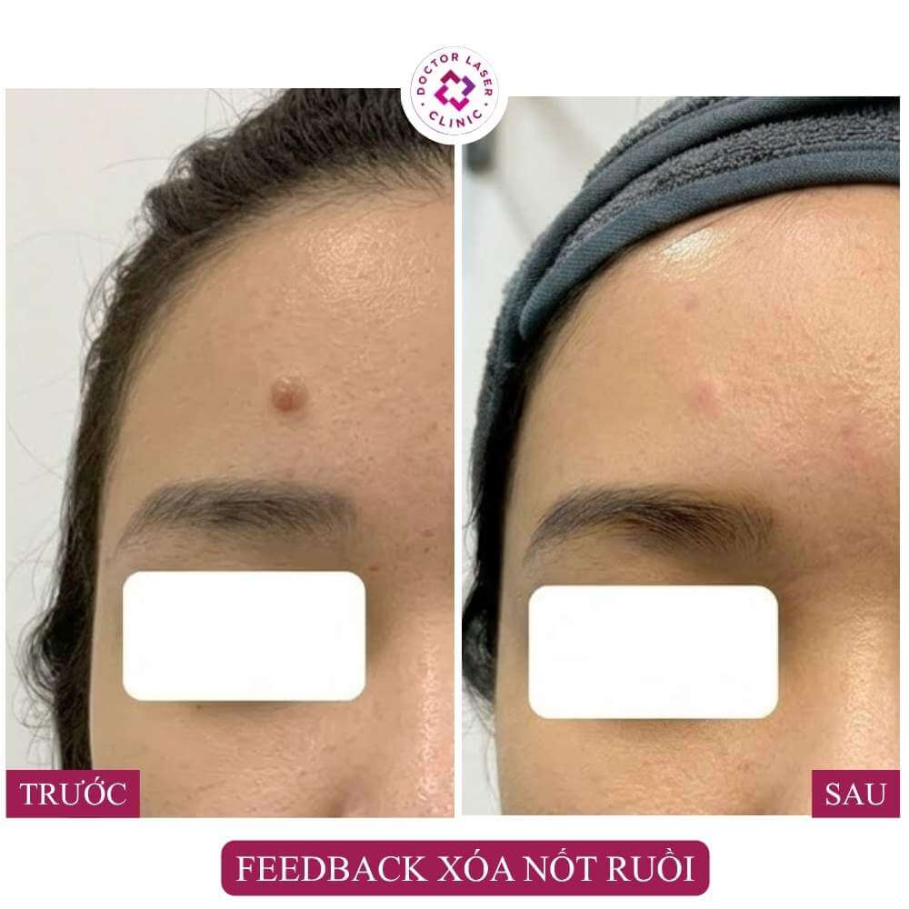 feedback xóa nốt ruồi trán