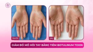 giảm đổ mồ hôi tay bằng tiêm botulinum toxin
