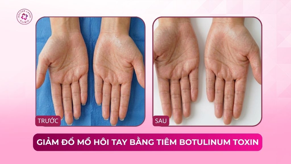 giảm đổ mồ hôi tay bằng tiêm botulinum toxin