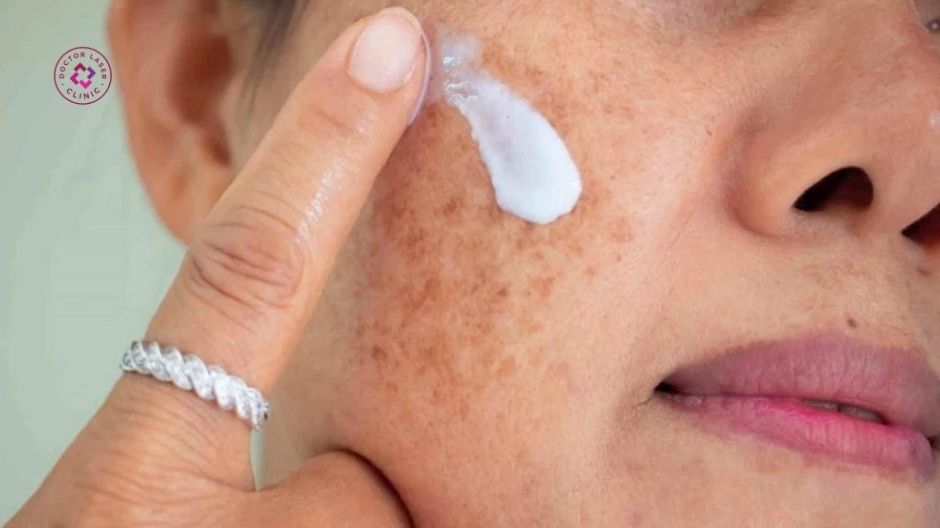 hoạt chất bôi thoa điều trị nám lâu năm