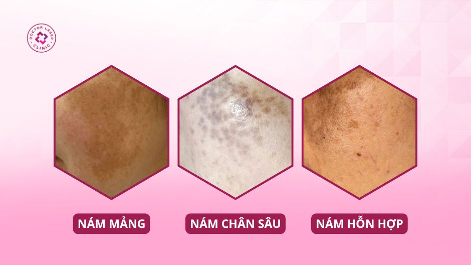 hướng dẫn cách trị nám theo từng phân loại