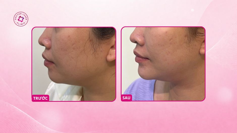 kết quả cằm sau tiêm ha