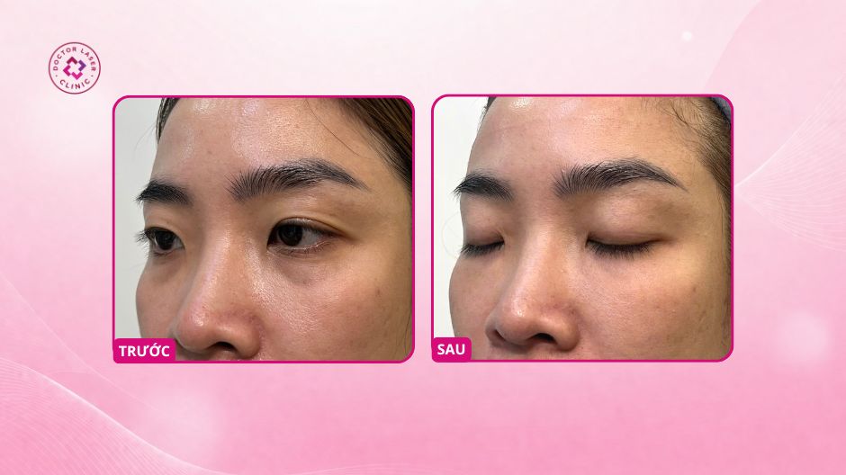 kết quả mắt trũng sau tiêm ha