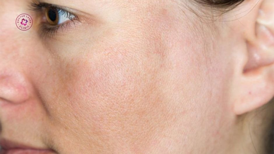 kích ứng mỹ phẩm gây nám nhẹ