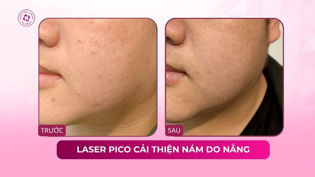 laser pico cải thiện nám do nắng