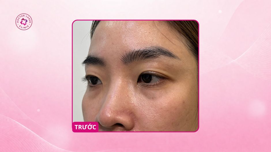 mắt thâm trũng trước tiêm HA