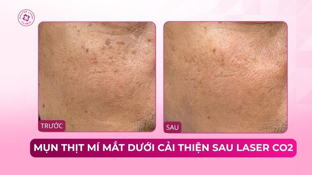 mụn thịt gần mí mắt dưới cải thiện sau laser co2
