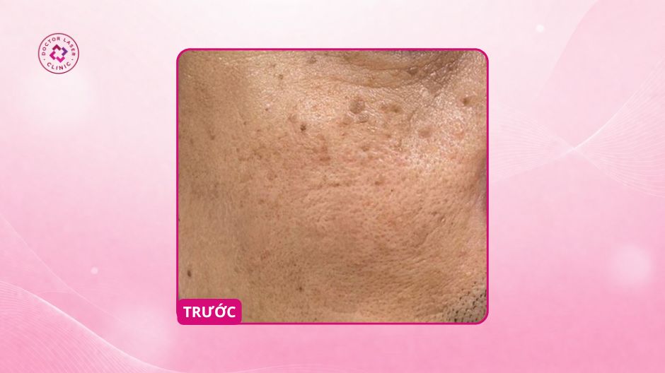 mụn thịt gần mí mắt dưới trước điều trị