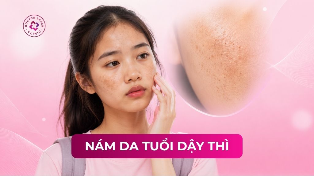 Nám da tuổi dậy thì: Nguyên nhân và các phương pháp điều trị