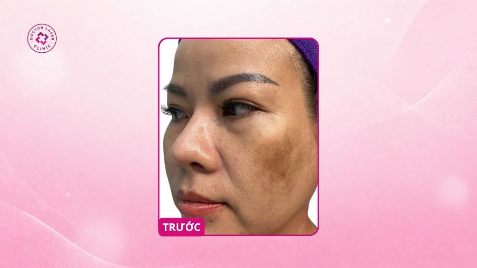 nám đậm hơn sau phi kim trước điều trị