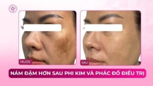 nám đậm hơn sau phi kim và phác đồ điều trị