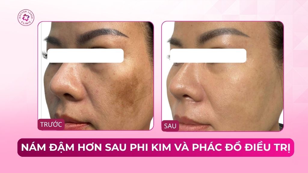 nám đậm hơn sau phi kim và phác đồ điều trị