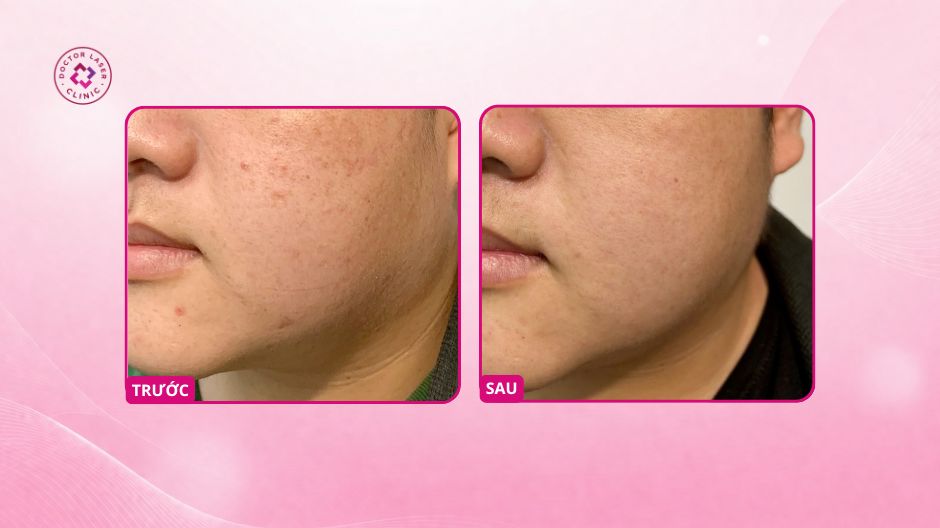 nám hai bên má sau laser pico