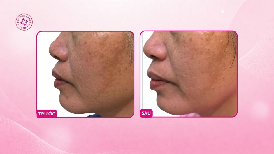 nám hỗn hợp toàn mặt sau 1 tháng điều trị