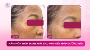 nám hỗn hợp toàn mặt sau prp kết hợp đường bôi