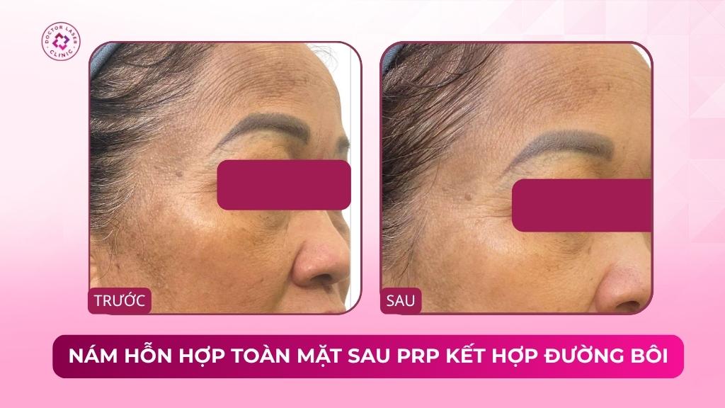 nám hỗn hợp toàn mặt sau prp kết hợp đường bôi