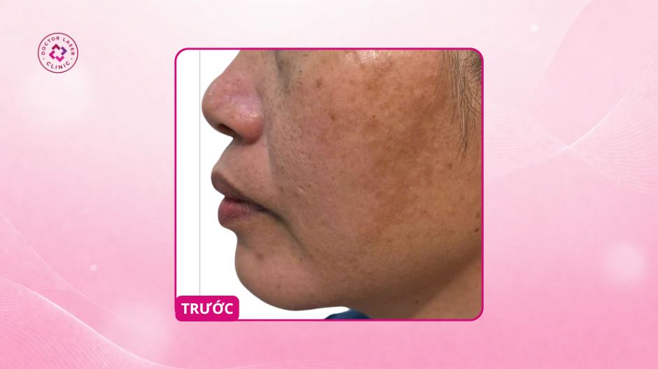nám hỗn hợp toàn mặt trước điều trị
