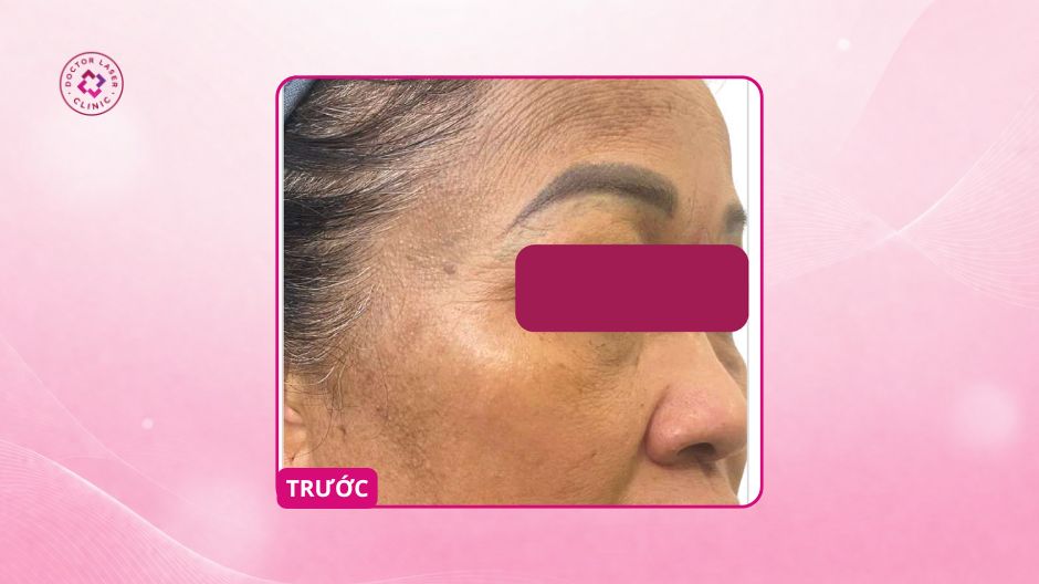 nám hỗn hợp toàn mặt trước prp và đường bôi