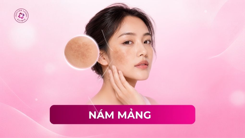 Nám mảng là gì? Dấu hiệu, nguyên nhân và phương pháp điều trị