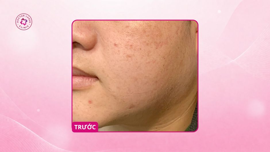 nám nhẹ hai bên má trước điều trị