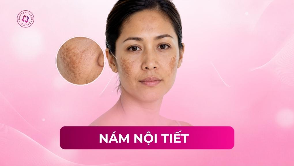 Nám nội tiết là gì? Nguyên nhân và các phương pháp điều trị