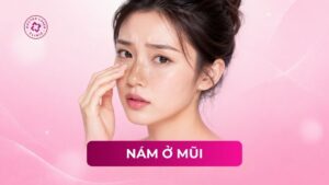 nám ở mũi
