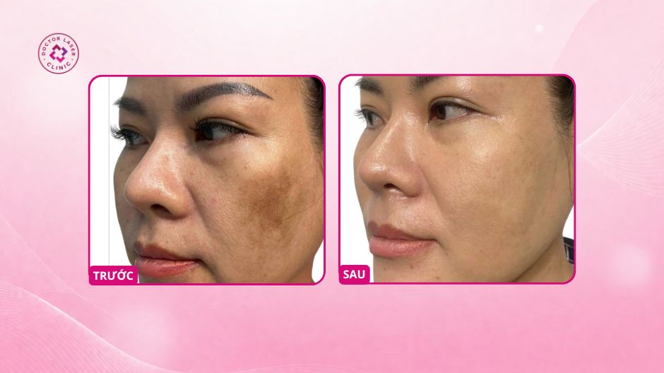 nám sau phi kim sau 3 tháng điều trị