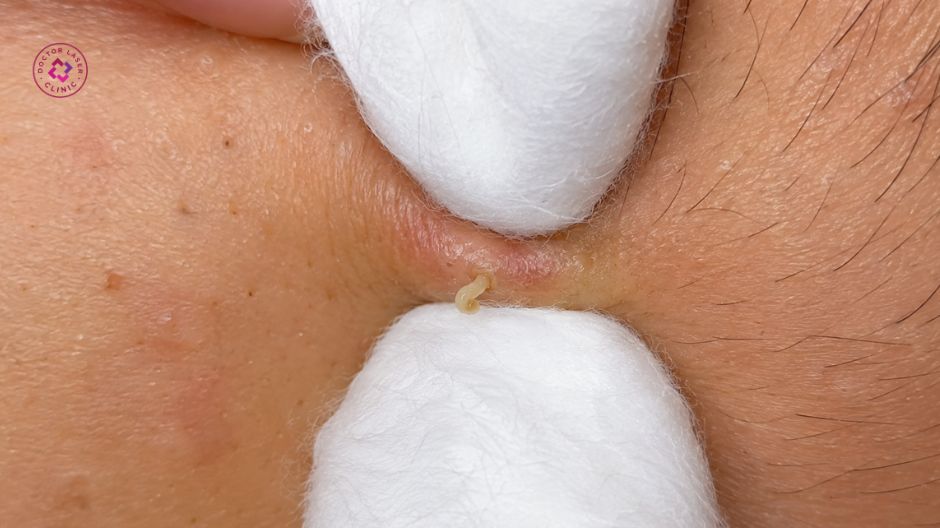 nguyên tắc nặn mụn tránh để lại thâm đen