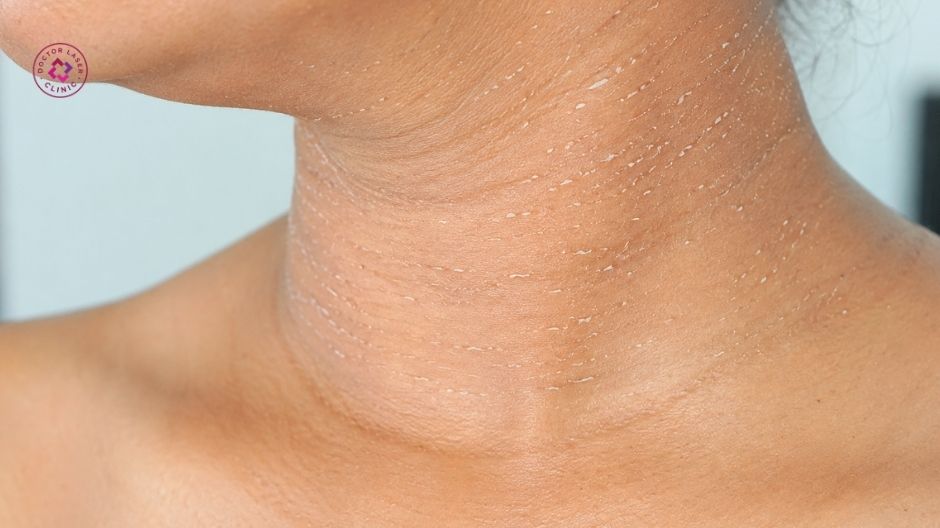 peel da cải thiện cổ bị thâm đen