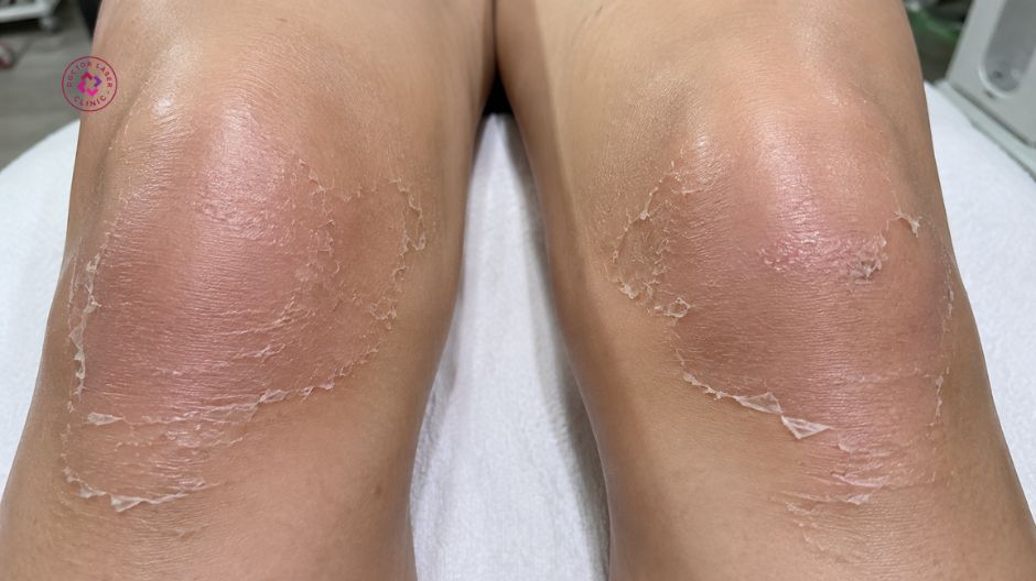 peel da hóa học điều trị thâm đầu gối