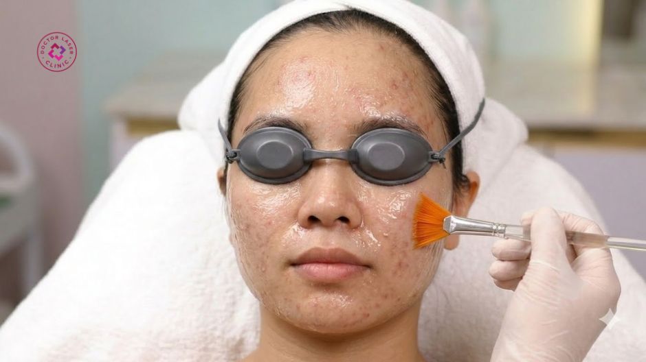 peel da hóa học trị thâm mụn nặng