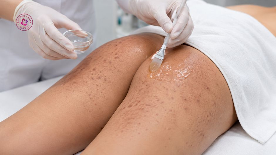 peel da trị thâm mụn ở mông
