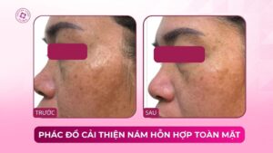 phác đồ cải thiện nám hỗn hợp toàn mặt