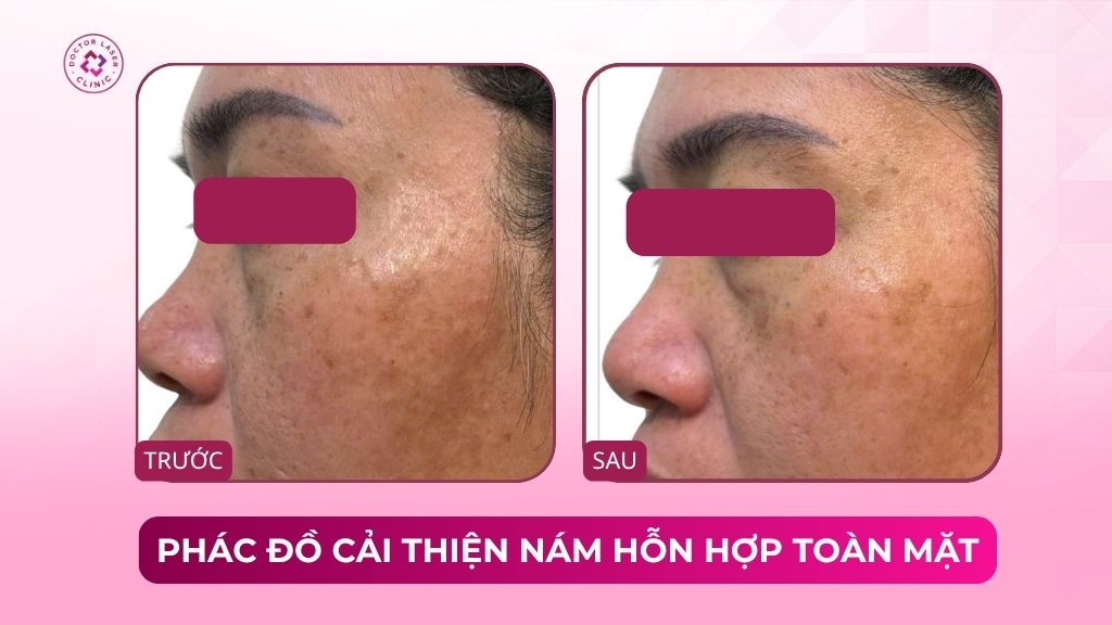 phác đồ cải thiện nám hỗn hợp toàn mặt