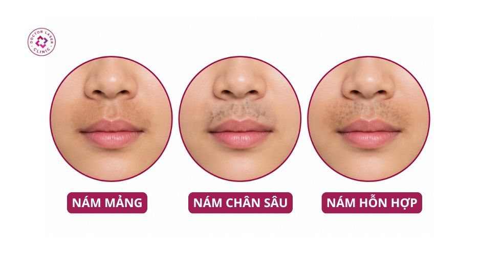 phân loại nám râu