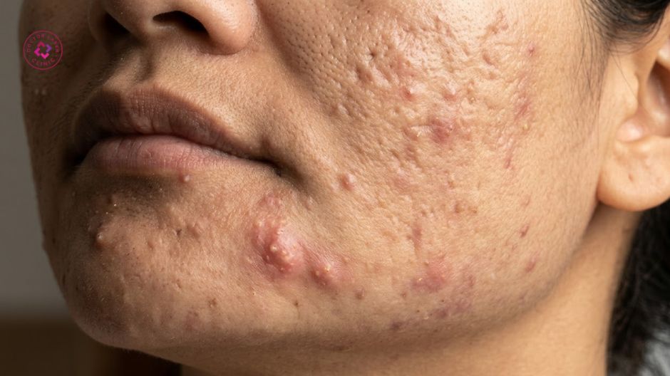 phản ứng viêm sâu của mụn bọc và mụn nang