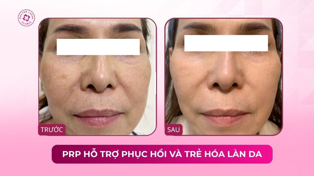 prp hỗ trợ phục hồi và trẻ hóa làn da