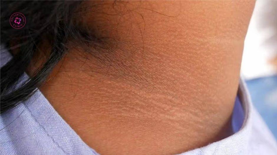 rối loạn nội tiết tố gây thâm cổ