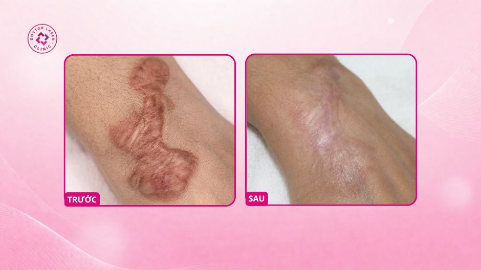 sẹo lồi ở chân sau tiêm corticosteroid
