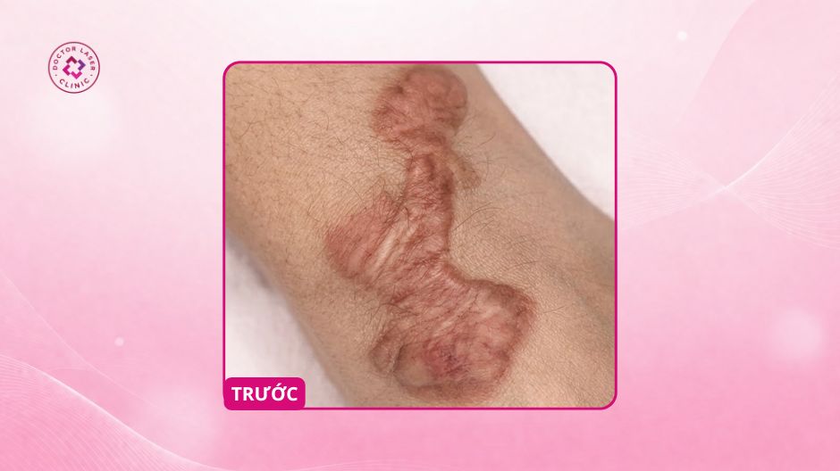 sẹo lồi ở chân trước điều trị